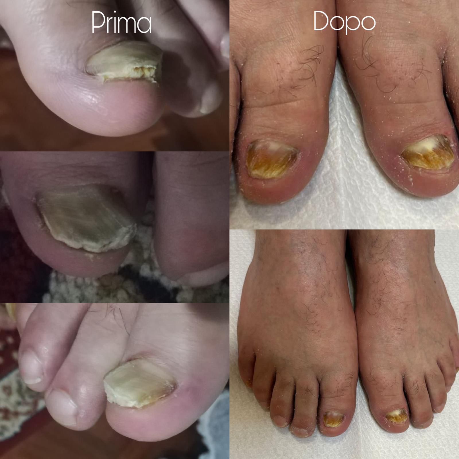 Risultati pedicure prima e dopo